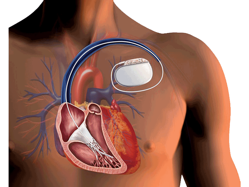 AICD Implantation By Dr Merajul Haque