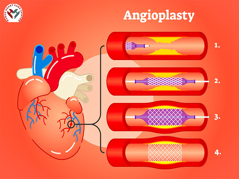 coronary angioplasty by Dr Merajul Haque