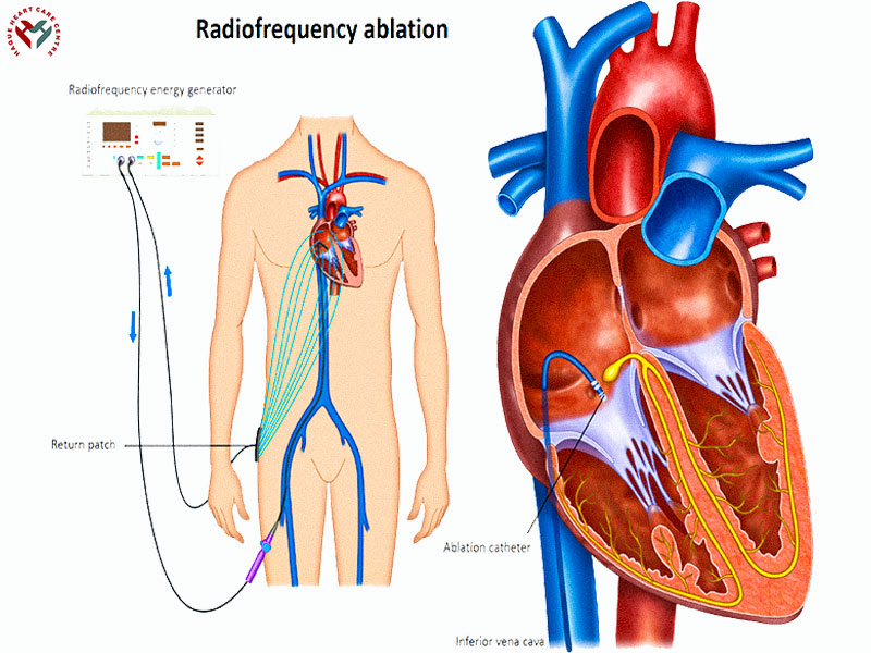 Dr Merajul Haque Catheter abalatation