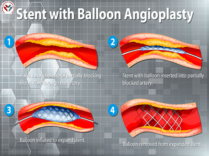Stent Balloon valvuloplasty by Dr Merajul Haque.