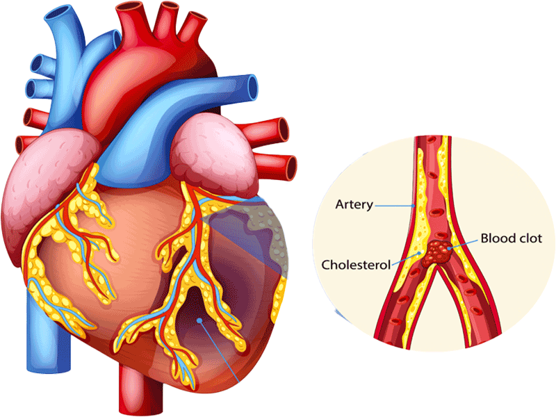 Coronary Angioplasty by Dr Merajul Haque