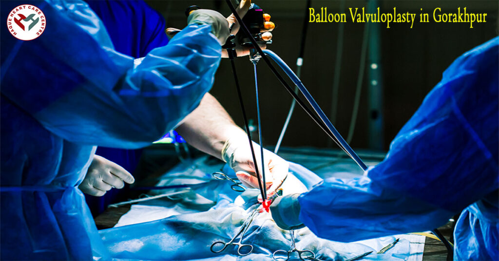 Balloon Valvuloplasty in Gorakhpur