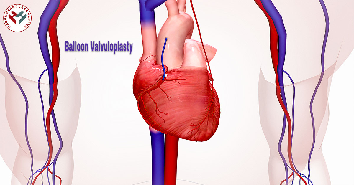 Balloon Valvuloplasty in Gorakhpur