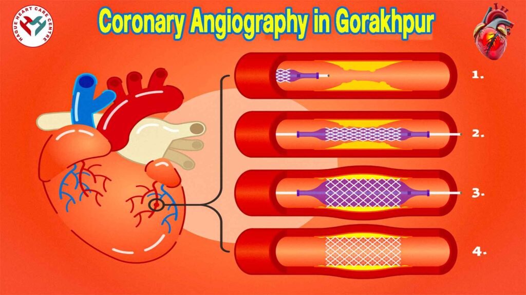 Coronary Angiography in Gorakhpur