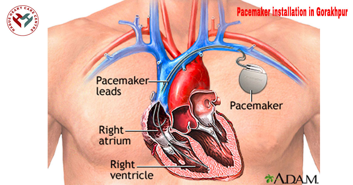 Pacemaker Installation in Gorakhpur
